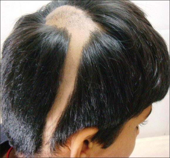 ijdvl 2013 79 5 563 116725 f9 Alopecia Areata: Exactly what You Had to Know